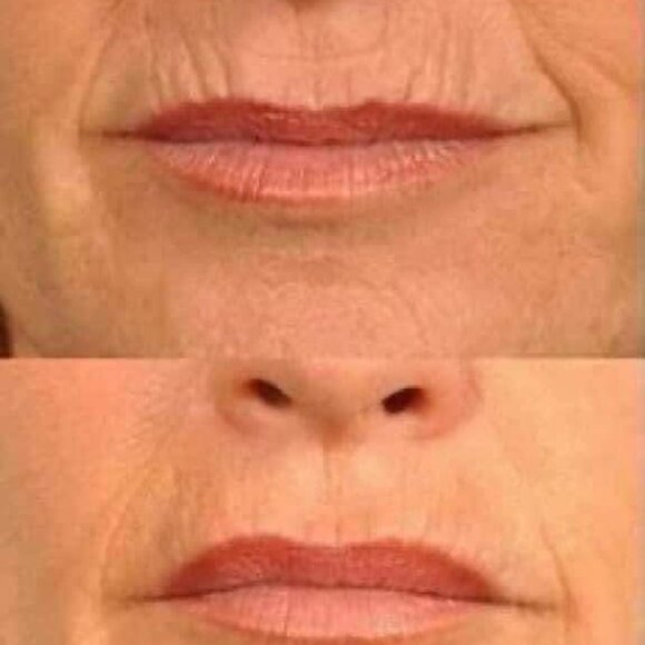 Tru Face® Line Corrector - Picture 5 of 5